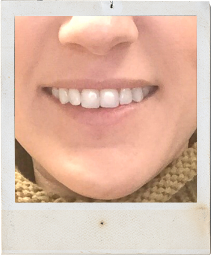 smilebrilliant before and after teeth whitening, best at home teeth whitening, teeth whitening for coffee stained teeth